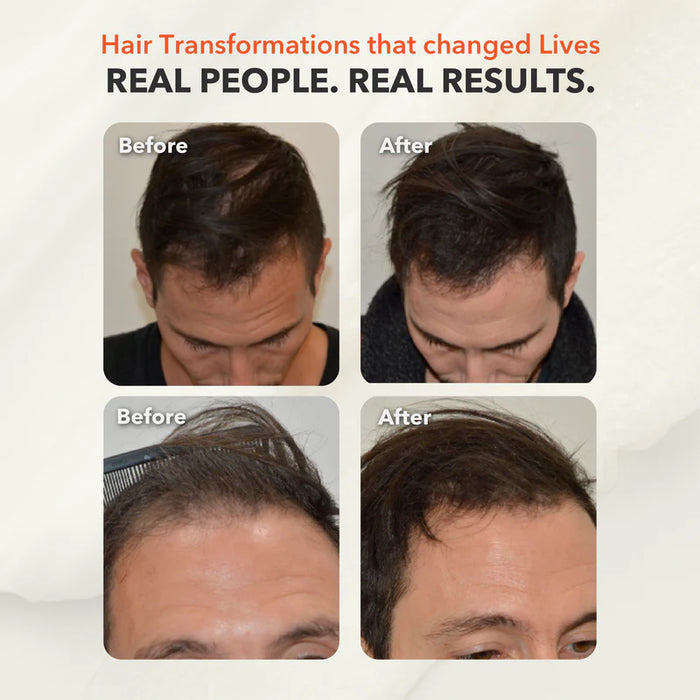 Grow 272 Laser Hair Therapy Cap – Clinically Proven Hair Regrowth