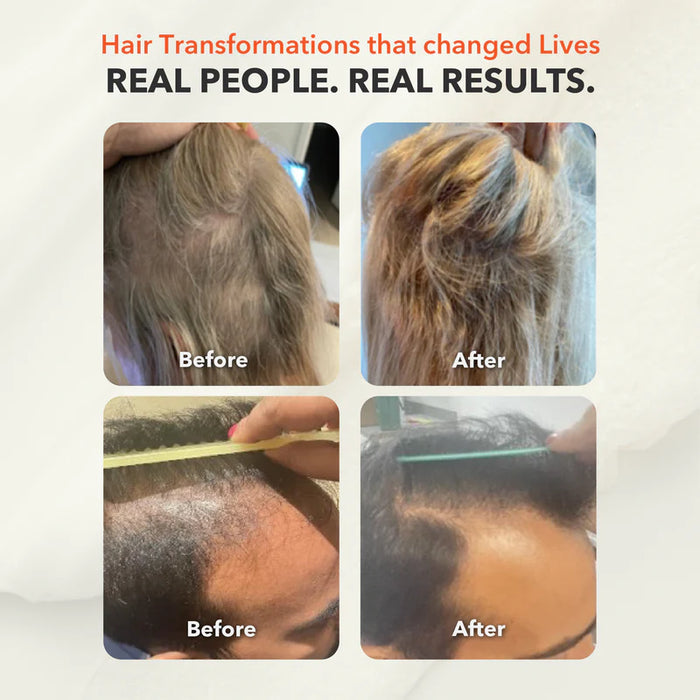 Grow 272 Laser Hair Therapy Cap – Clinically Proven Hair Regrowth