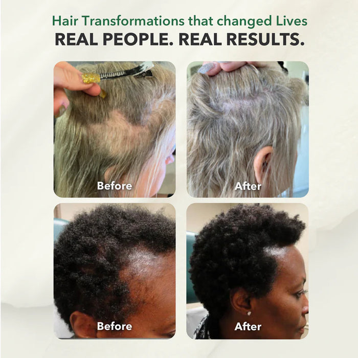 Pro for Women: Clinically Advanced 4-Step System for Hair Regrowth & Strength