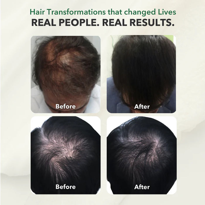 100% Natural DHT BLOCKER for Genetic Hair Loss in Men & Women; 60 Capsules